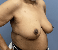 Breast Reduction
