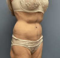 Circumferential Body Lift