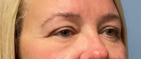 Eyelid Surgery