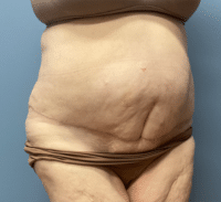Panniculectomy