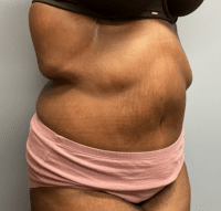 Panniculectomy
