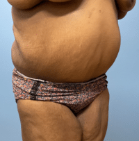 Panniculectomy