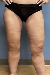 Thigh Lift