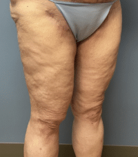 Thigh Lift