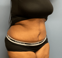 Tummy Tuck