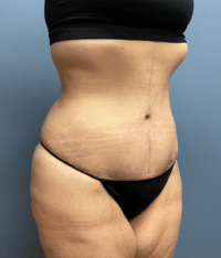 Tummy Tuck