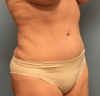 Tummy Tuck