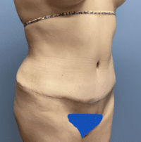 Tummy Tuck