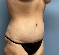 Tummy Tuck