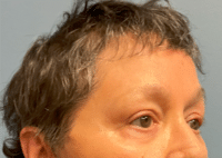 Brow Lift