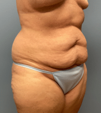 Tummy Tuck