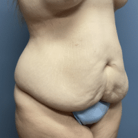 Tummy Tuck