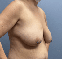Breast Lift