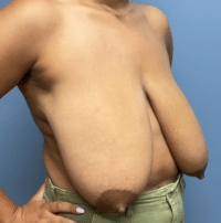 Breast Reduction