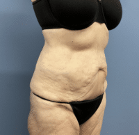 Circumferential Body Lift