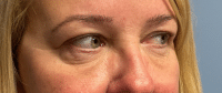 Eyelid Surgery