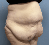 Panniculectomy