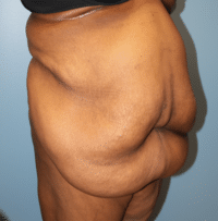 Panniculectomy
