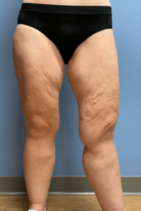 Thigh Lift