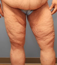 Thigh Lift