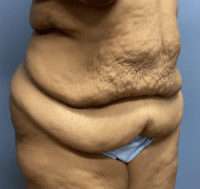 Tummy Tuck