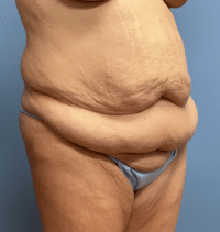 Tummy Tuck