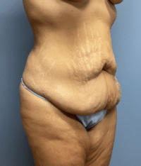Tummy Tuck