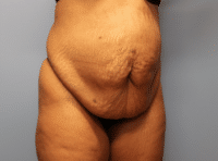 Tummy Tuck