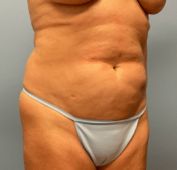 Tummy Tuck