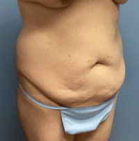 Tummy Tuck