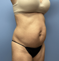 Tummy Tuck