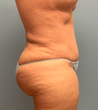 Tummy Tuck