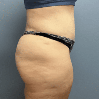 Tummy Tuck