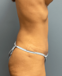 Tummy Tuck