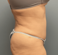 Tummy Tuck