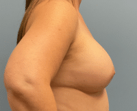 Breast Augmentation
