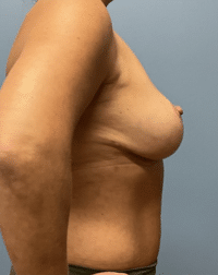 Breast Lift