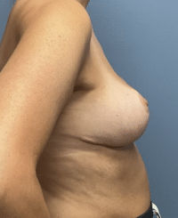 Breast Lift