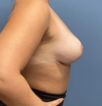 Breast Lift