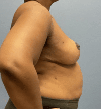 Breast Lift