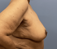 Breast Reduction