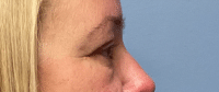 Eyelid Surgery