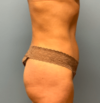 Liposuction
