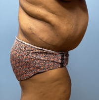 Panniculectomy
