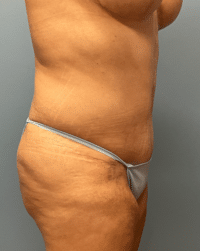 Tummy Tuck