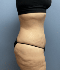 Tummy Tuck
