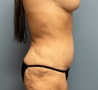 Tummy Tuck