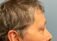 Brow Lift