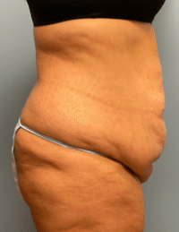 Tummy Tuck