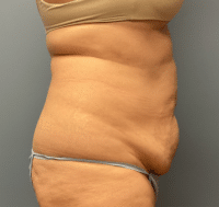 Tummy Tuck